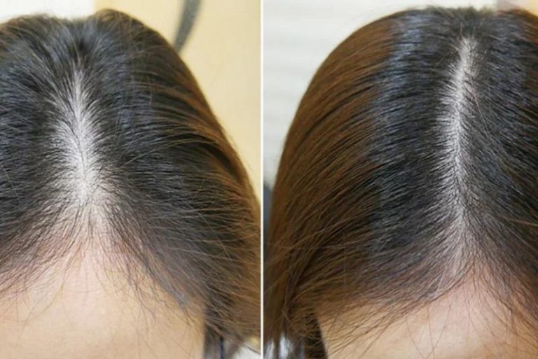 “Hair fall before and after transformation showing strong healthy shiny hair growth results”