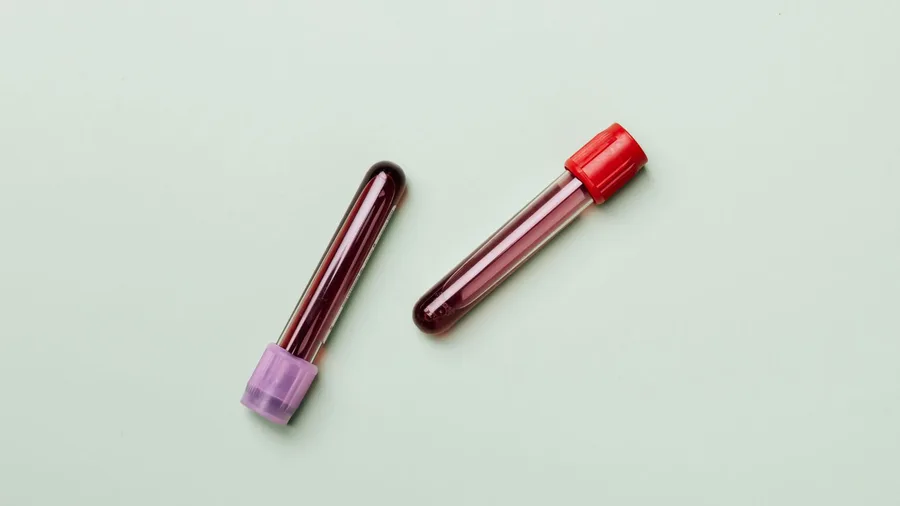 Blood Type B Tied to a Higher Risk of Type 2 Diabetes 2 Only Blood Type B Cleared the Bar